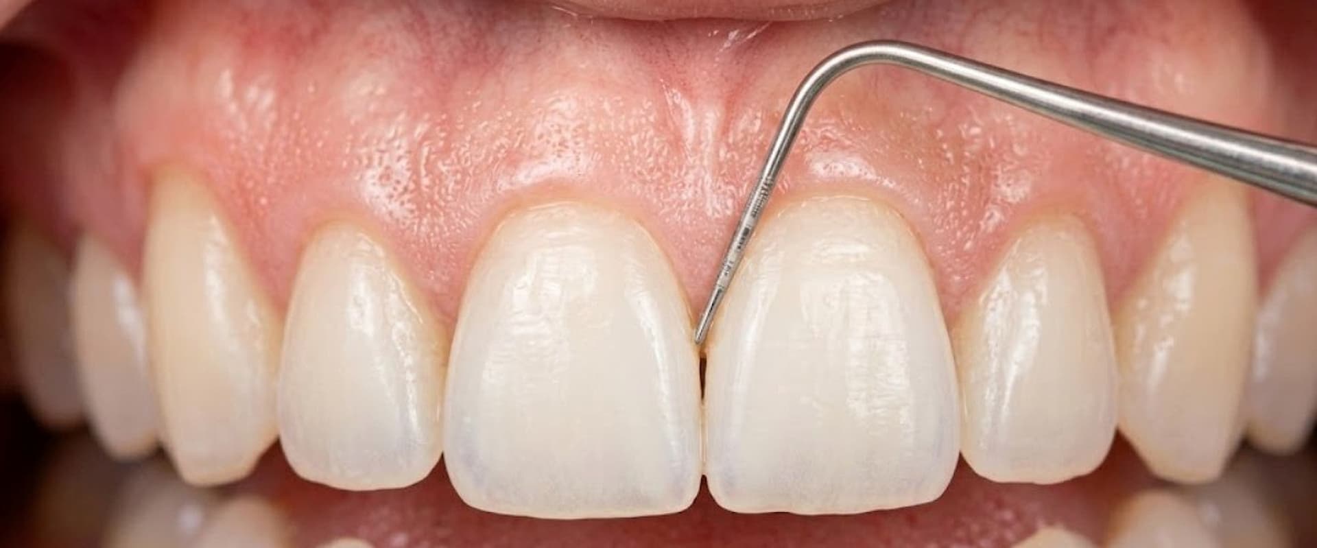 Tratamiento periodontal de encías con instrumento dental especializado
