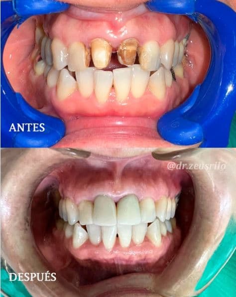 Caso de éxito - paciente Dental Rilo, periodoncia e implantes